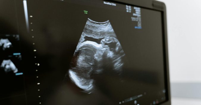 Ultrasound monitor. Photo by Mart Production, Pexels.